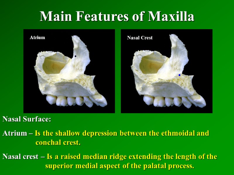 Main Features of Maxilla   Nasal Surface: Atrium – Is the shallow depression